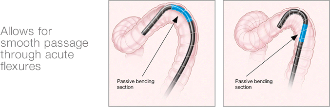 Allows for smooth passage through acute flexures